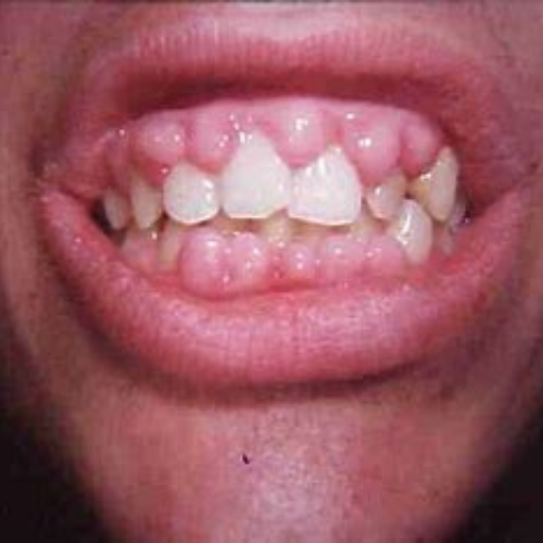 "Understanding Gingivitis: Uncovering Its Telltale Signs"